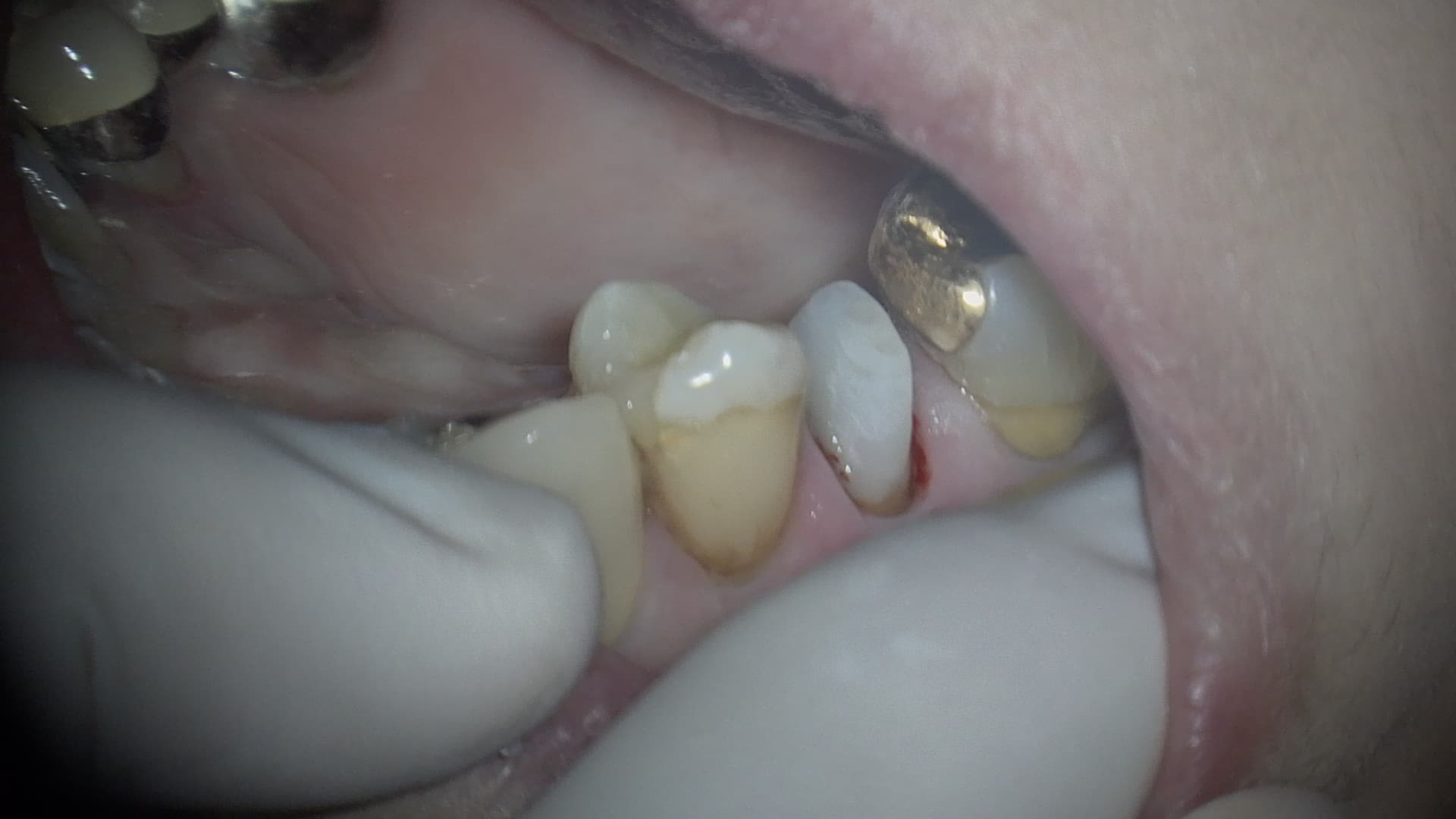 歯を残す治療　Part 1