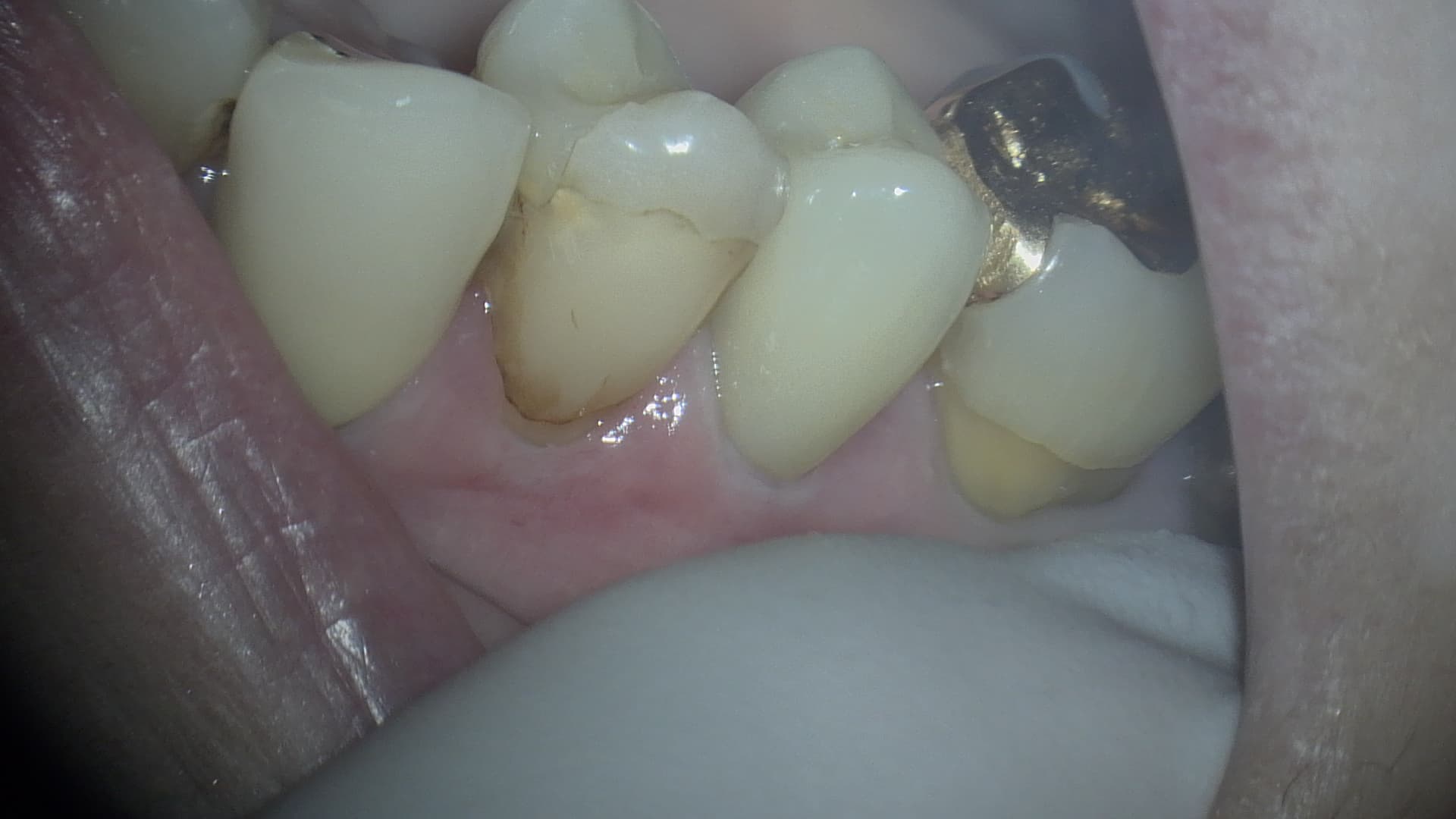 歯を残す治療　Part 1