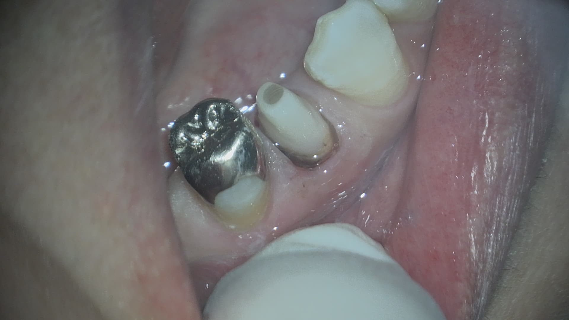 歯を残す治療　Part 2