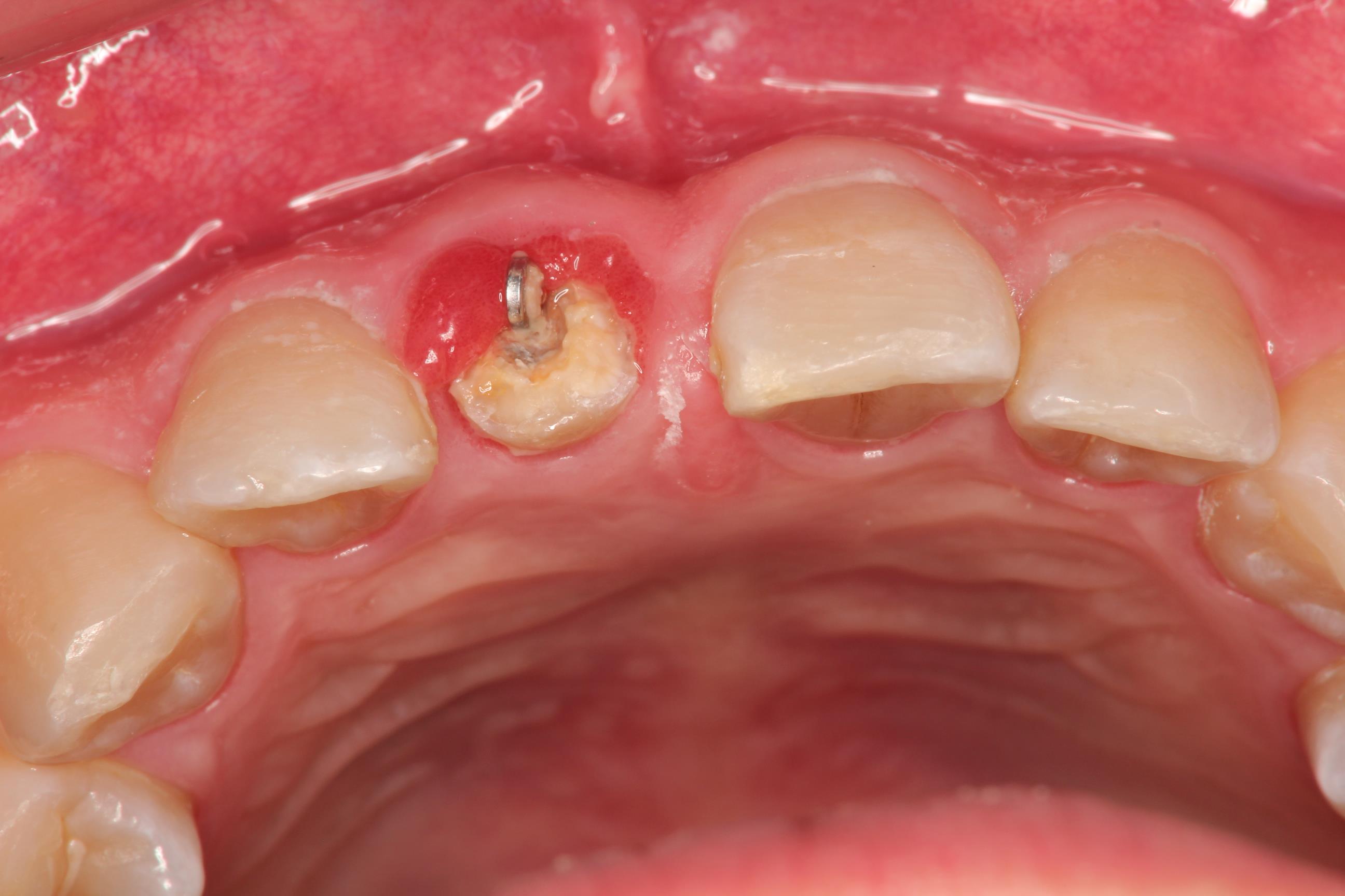 歯を残す治療　Part 3
