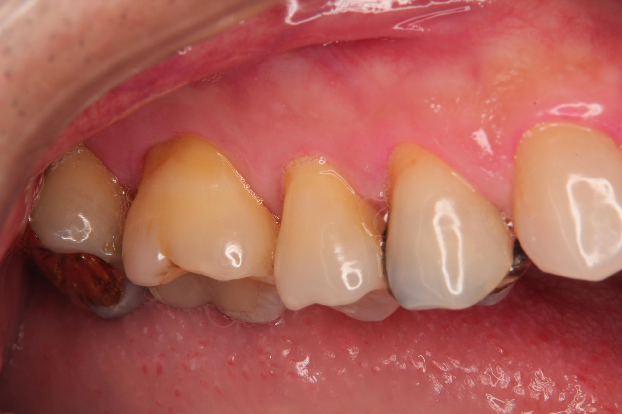 歯茎の移植
