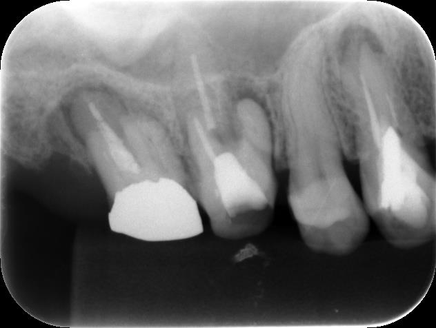歯根端切除術（他院にて抜歯と診断された歯）