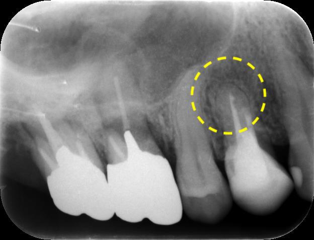 歯根端切除術（他院にて抜歯と診断された歯）