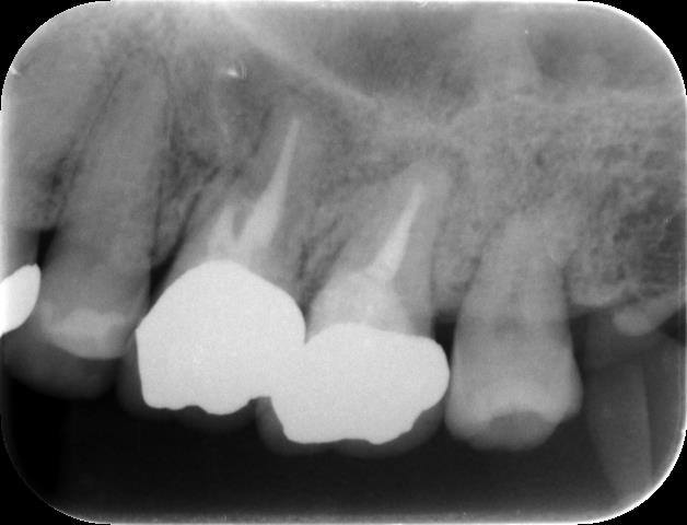 歯の再植術(他院にて抜歯と診断された歯）