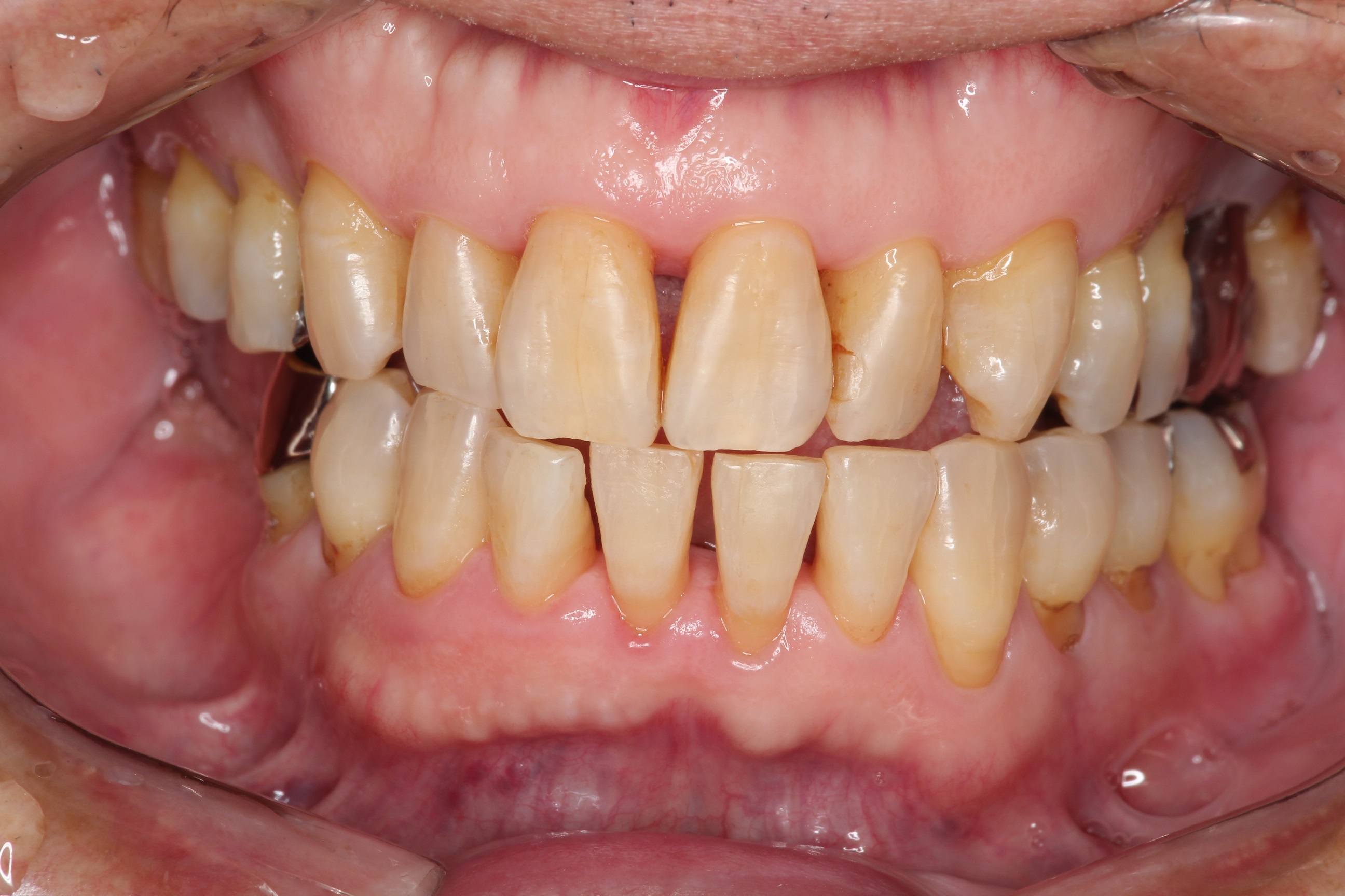 歯のステイン除去