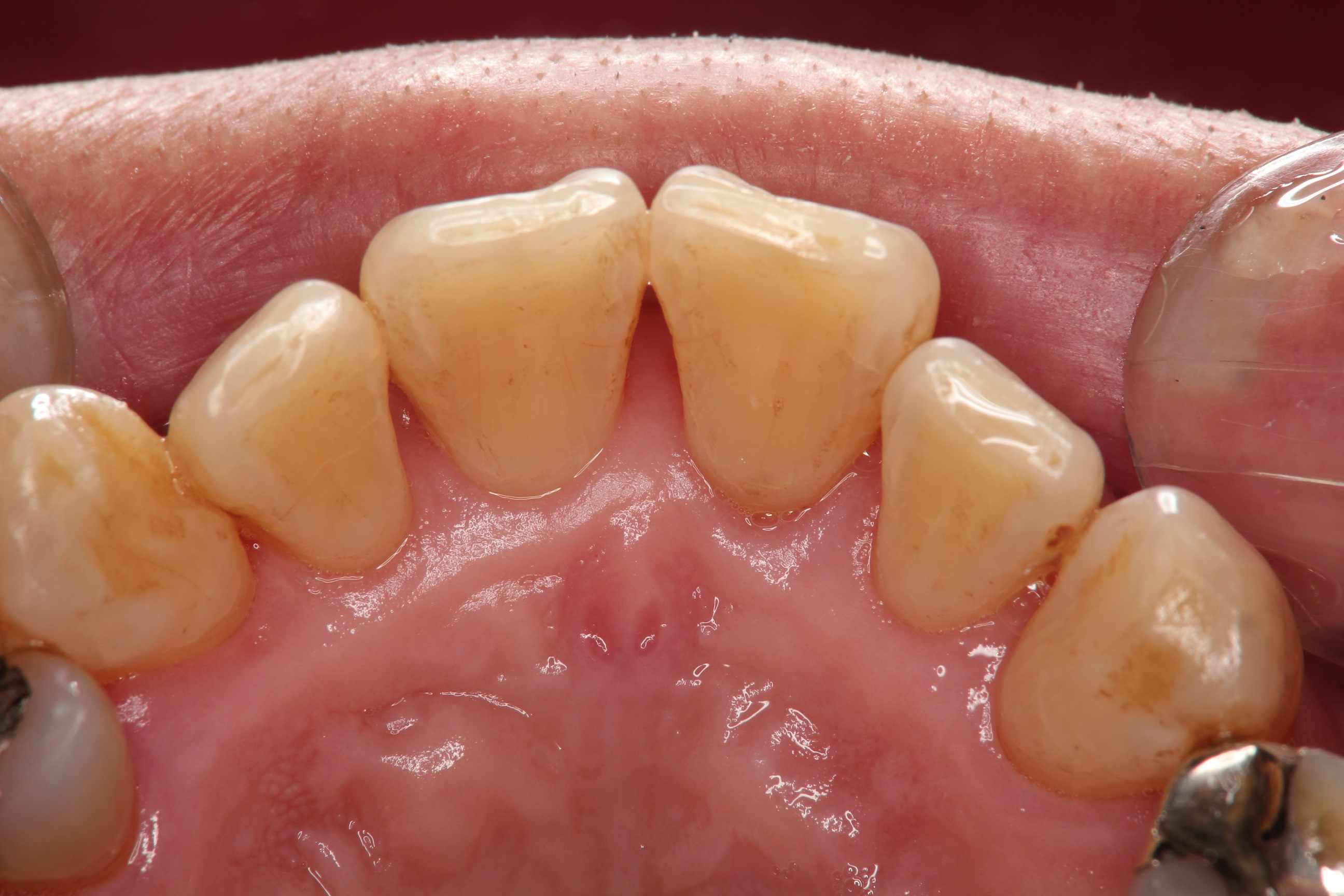歯のステイン除去