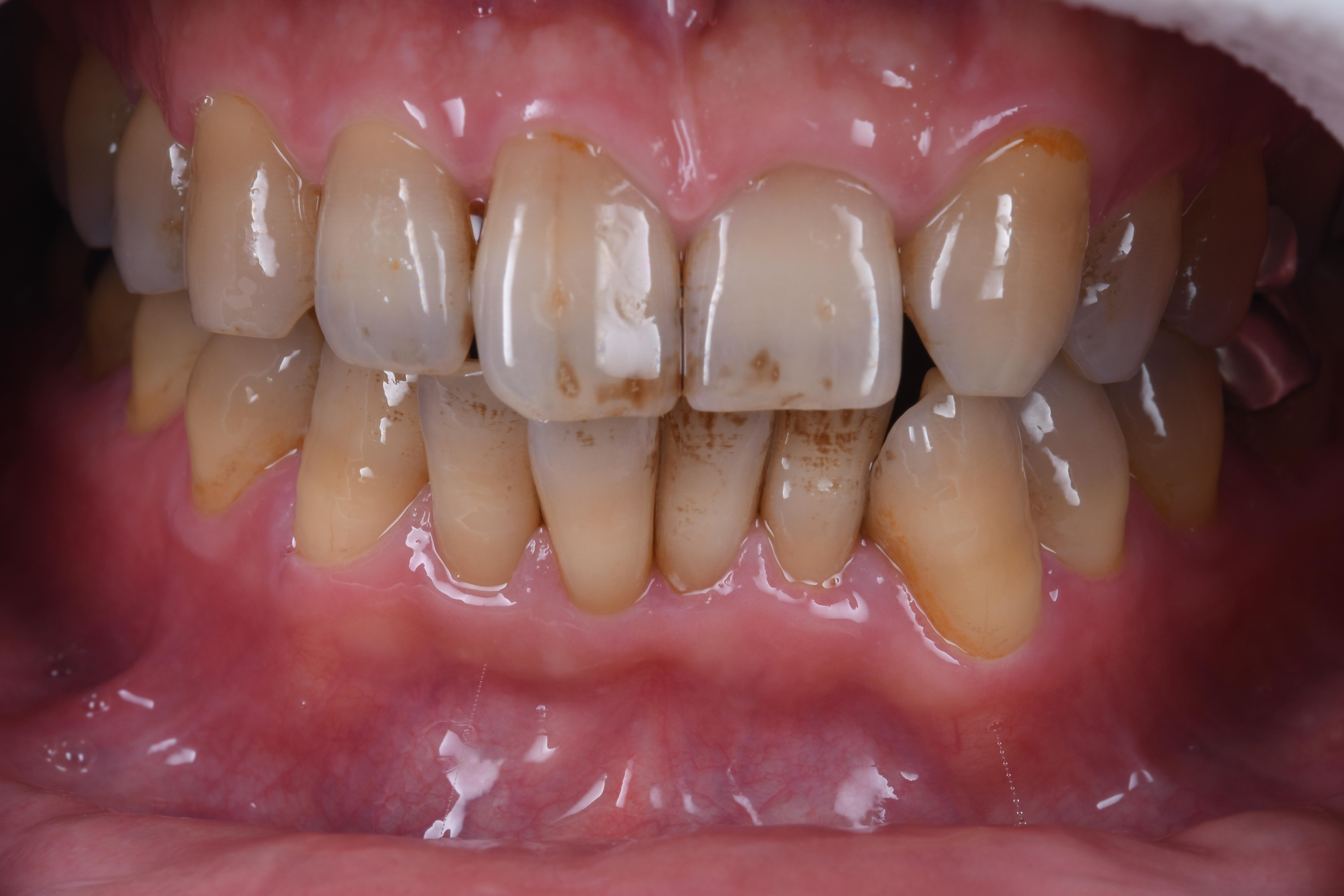 歯のステイン除去２