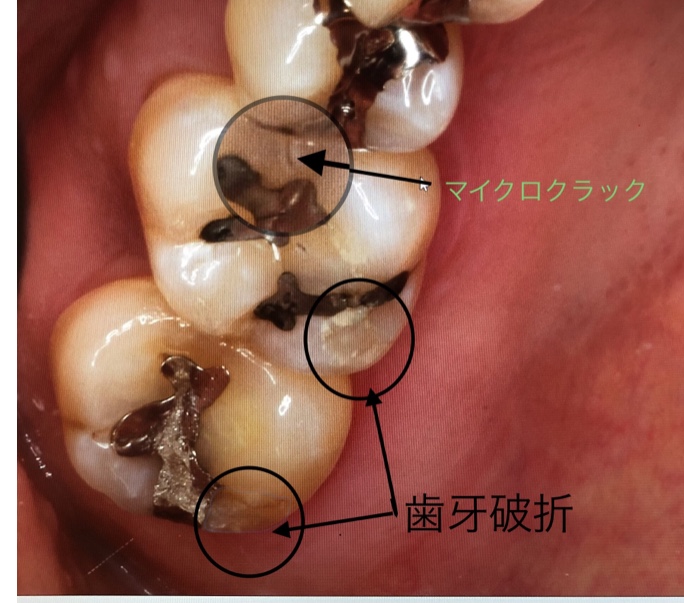 メンテナンスに通っているのになぜ歯を喪失してしまうのか…⁉︎