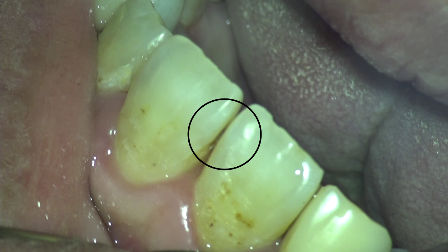 歯と歯の間の虫歯