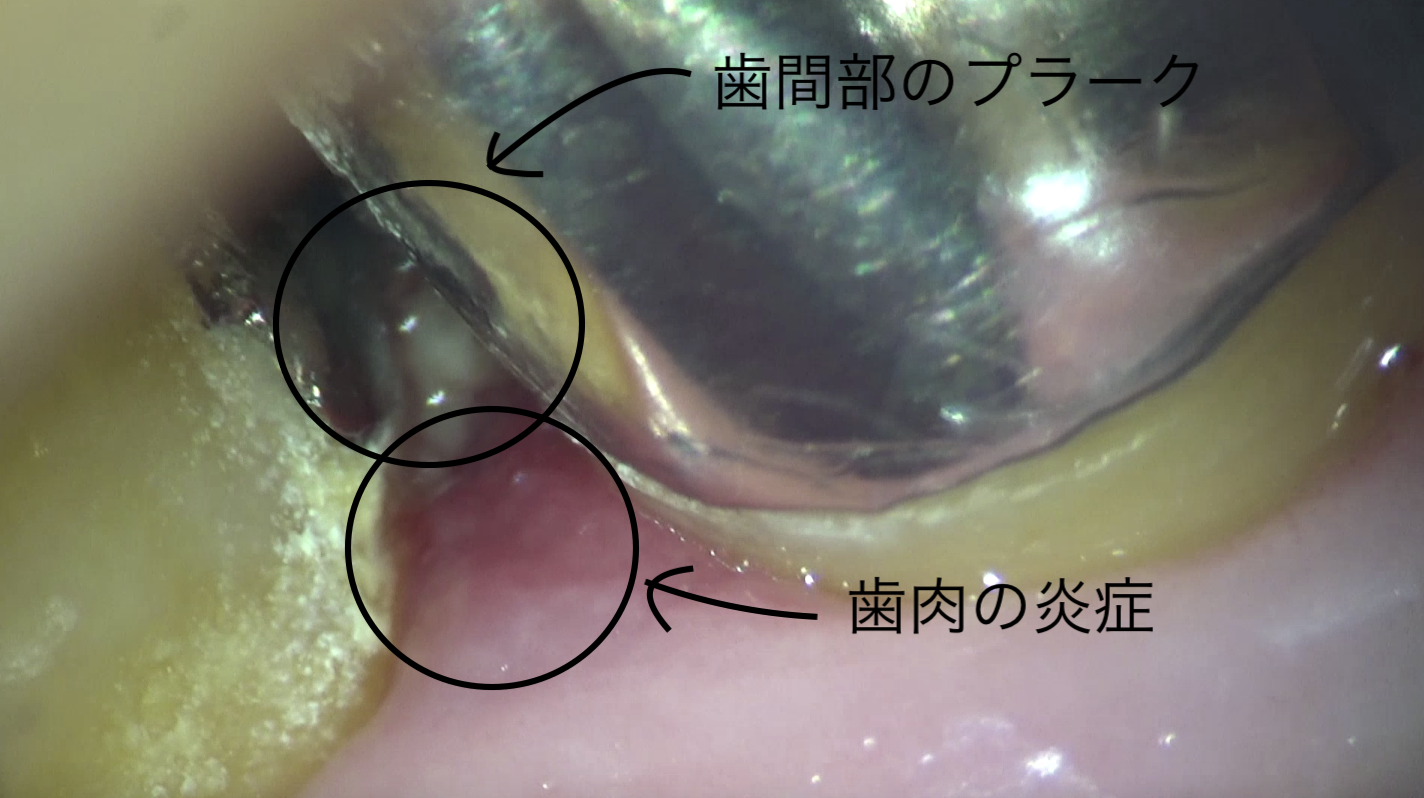 歯科衛生士は口の中の何をみているか？