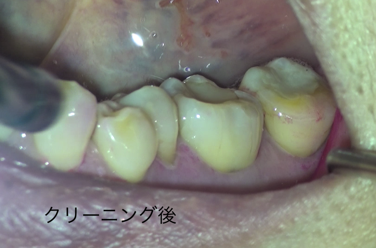 プラークは見えづらい