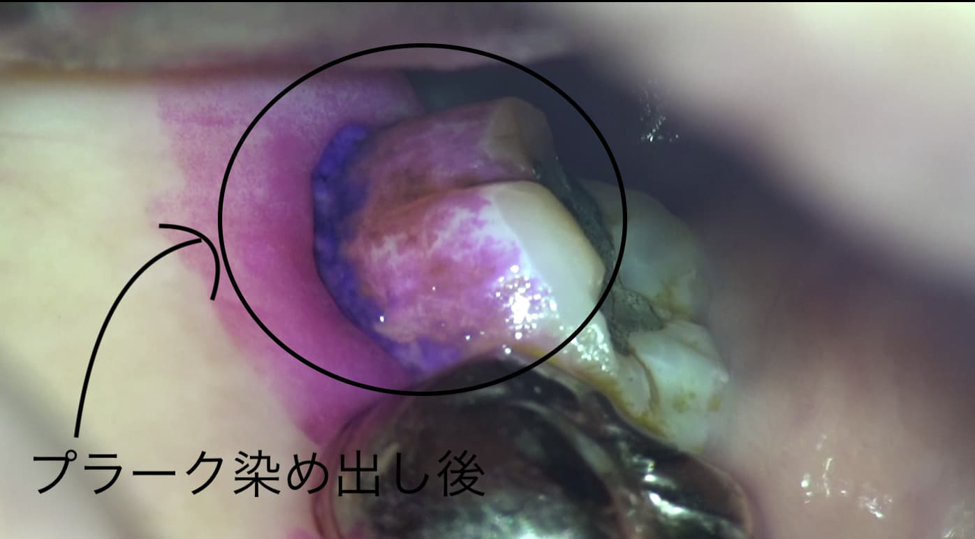 プラークの染め出し液