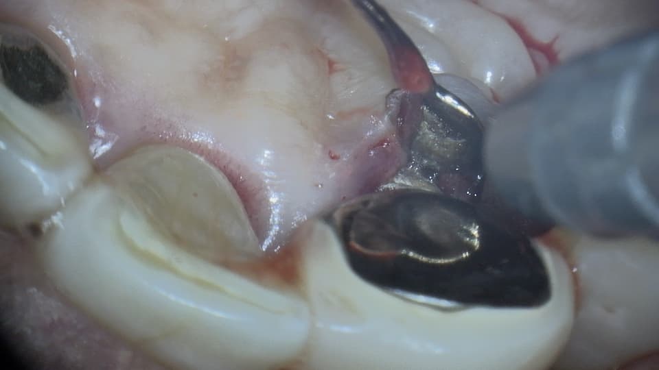 補綴物下についた歯石（マイクロスコープ 症例）