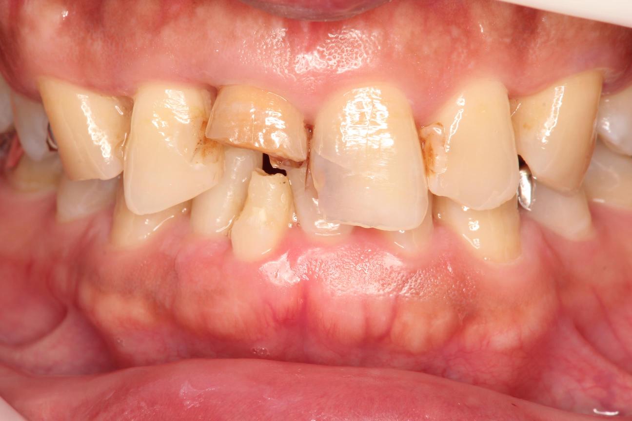 破折歯の治療