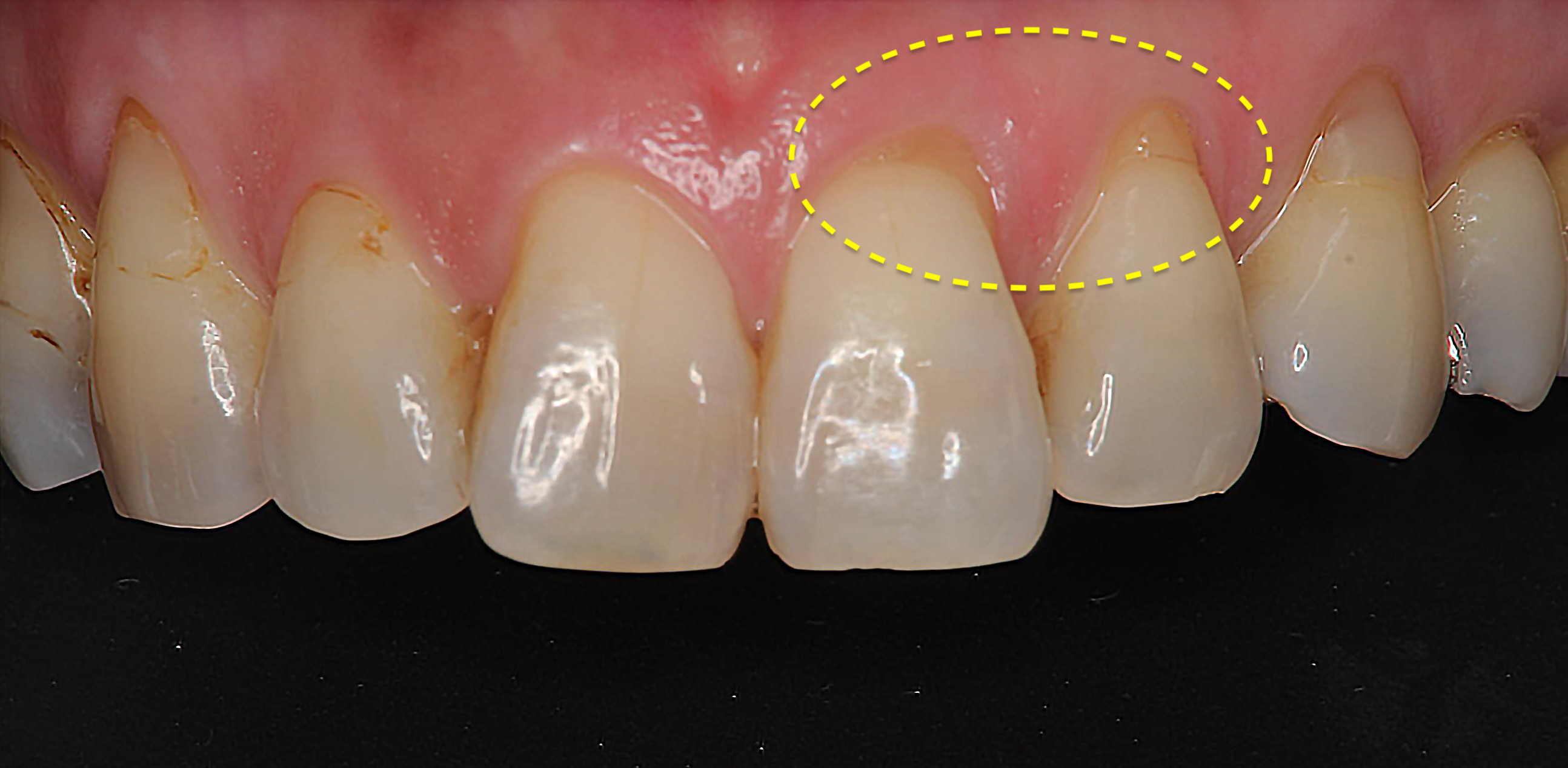 歯周組織再生療法の経過