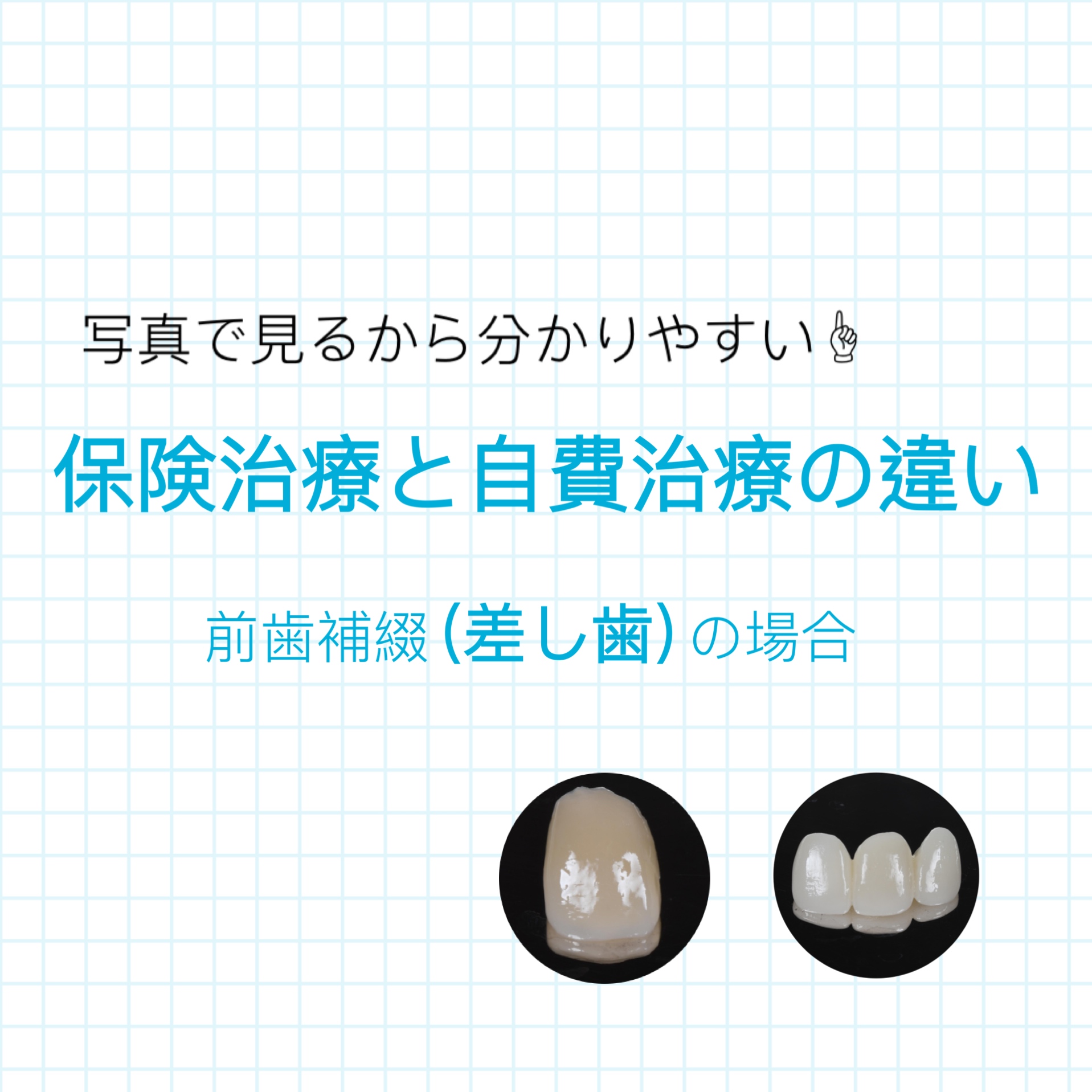 保険治療と自費治療の違い〜前歯補綴（被せ物）の場合〜