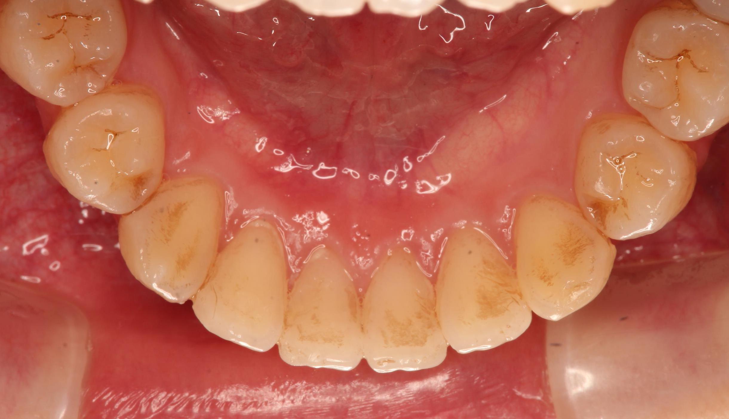 歯のステイン除去３