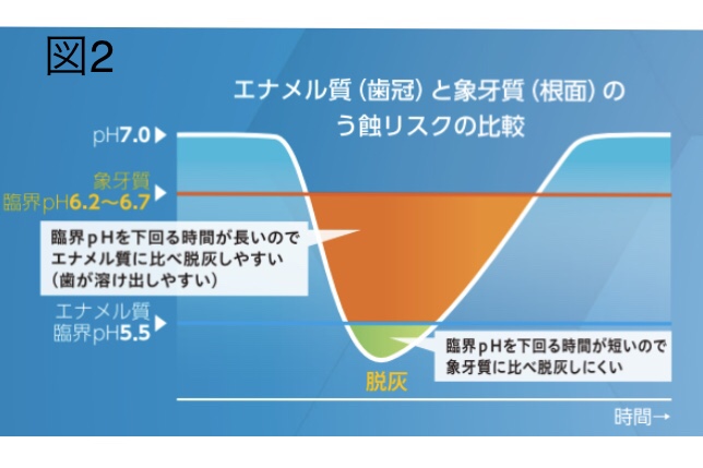 根面う蝕②