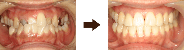 矯正＋セラミック修復