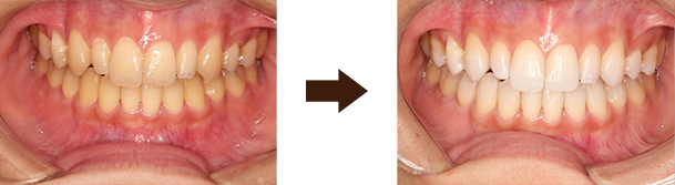 ホームホワイトニング2