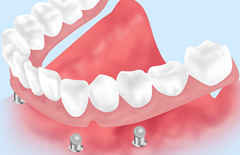 インプラントオーバーデンチャー