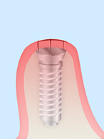 STEP3.治癒期間