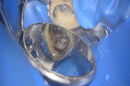 他院にて根の治療を何回も繰り返し行われていて、抜歯と診断された歯を保存。
          レントゲン上で不透過性が高まっており骨が再生されているのが認められます。