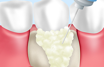 「歯周組織再生療法」