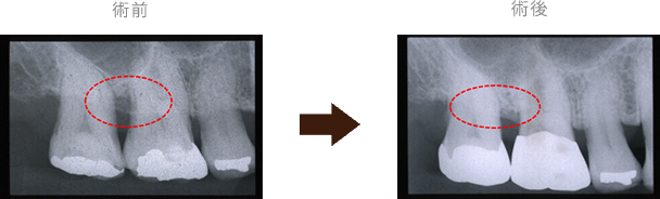 歯周再生治療法（エムドゲイン）