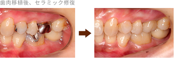 歯周外科処置後、セラミック修復