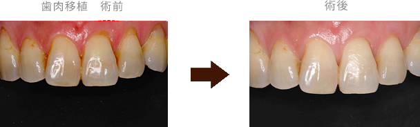 歯肉移植