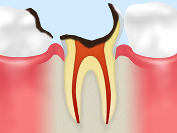 末期の虫歯