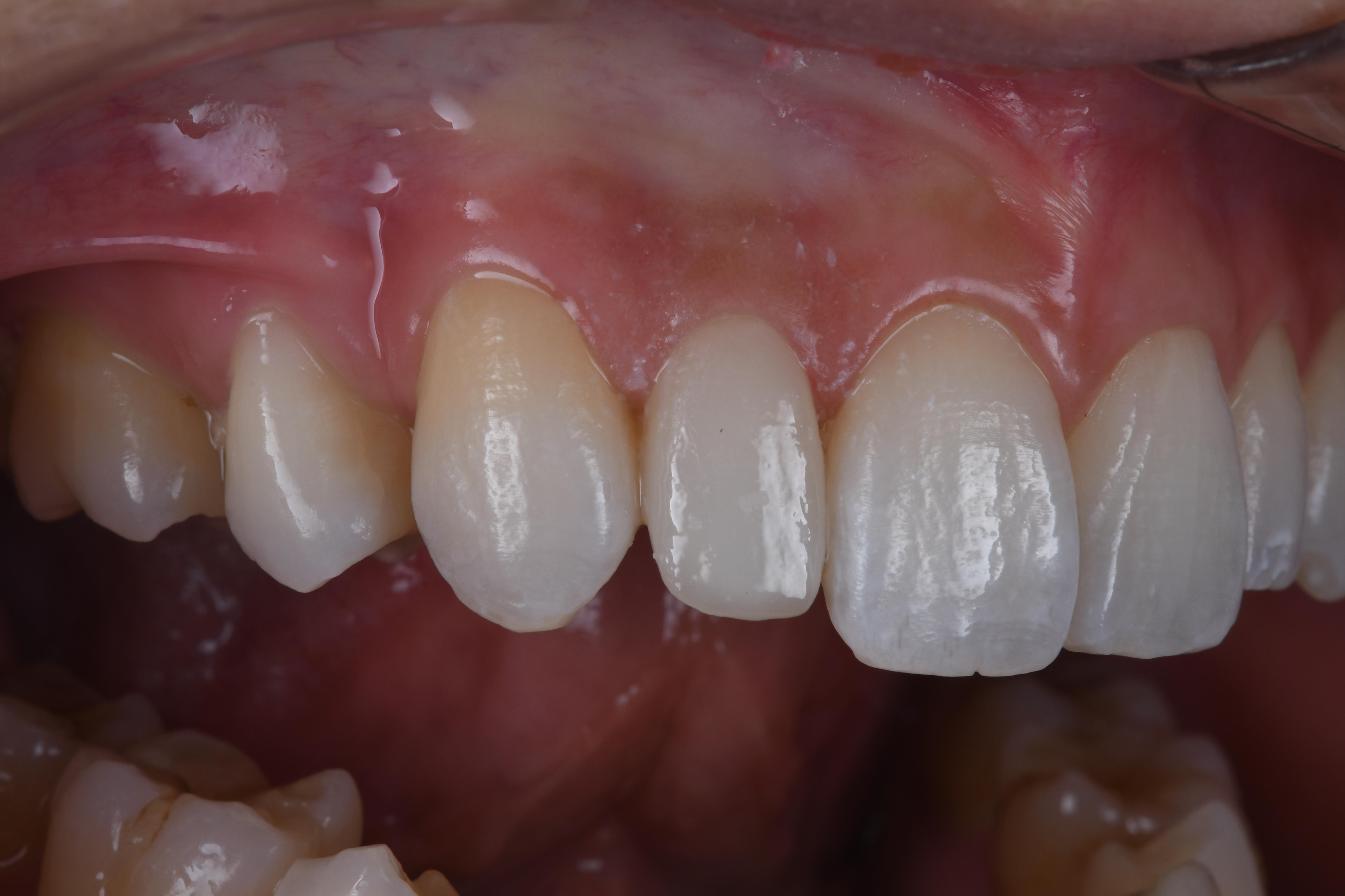 超低侵襲性のセラミック治療