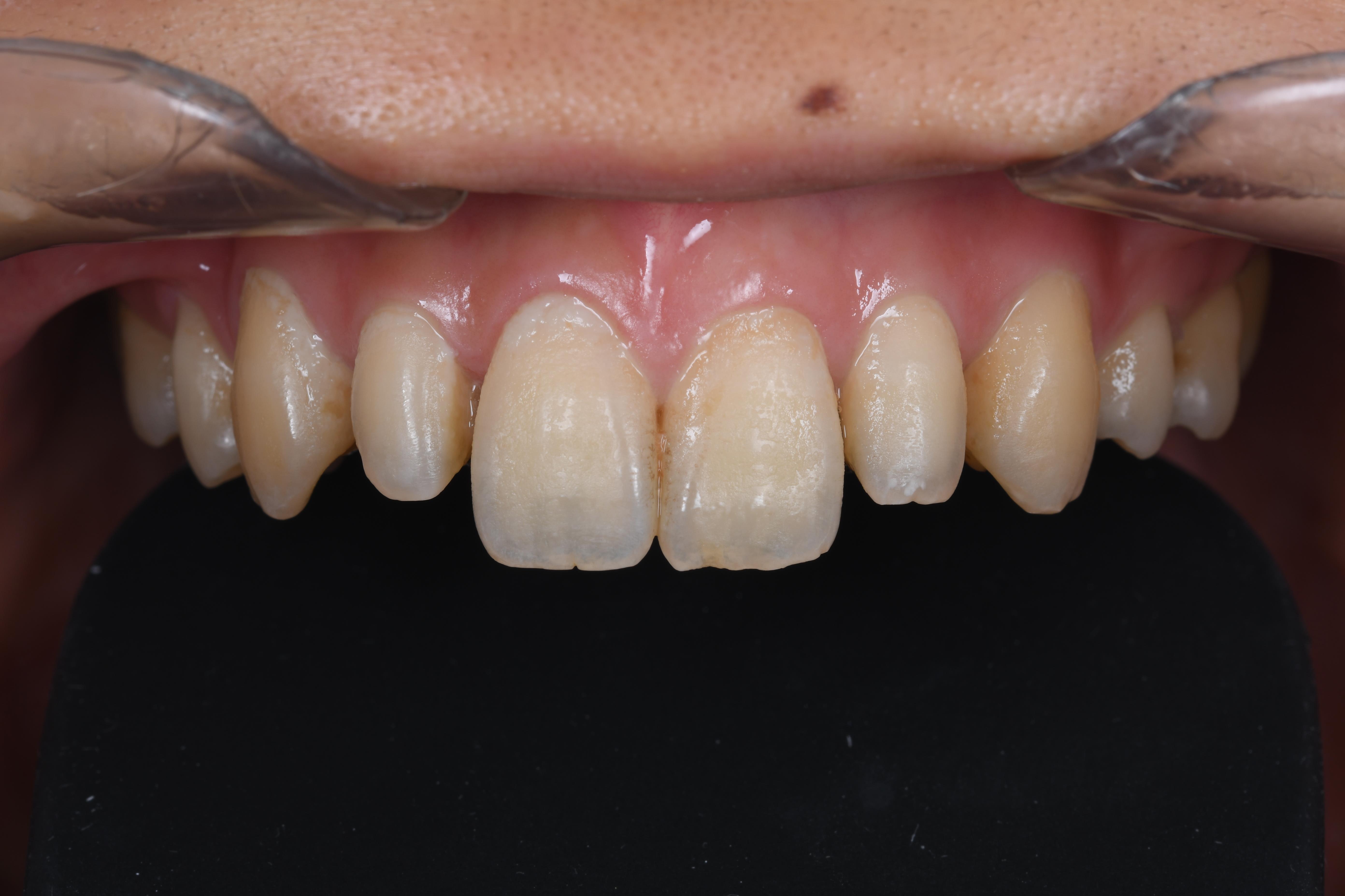 超低侵襲性のセラミック治療