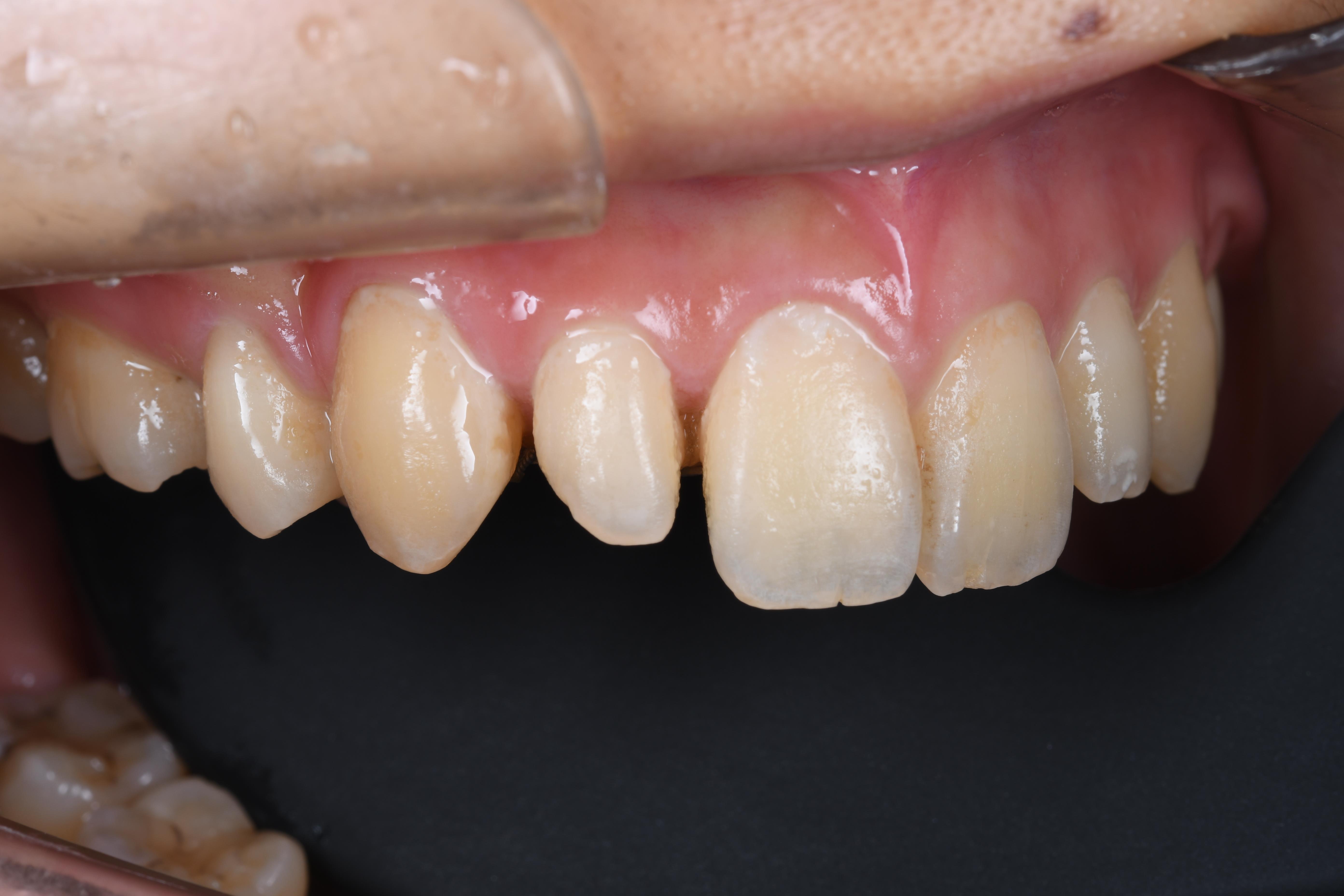 超低侵襲性のセラミック治療