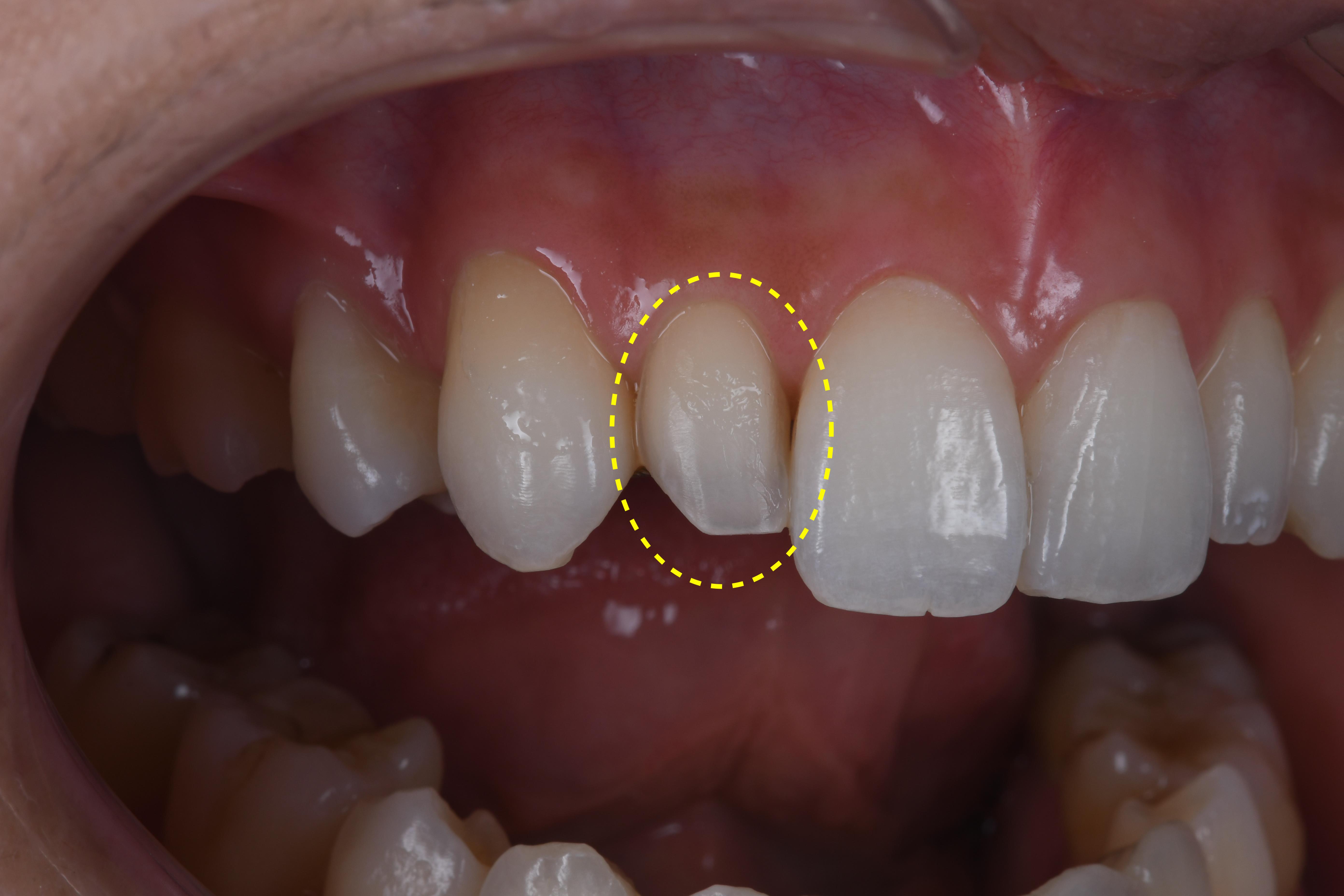 超低侵襲性のセラミック治療