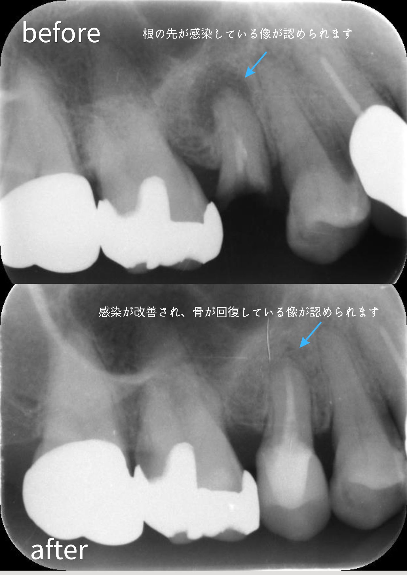 歯を残す治療