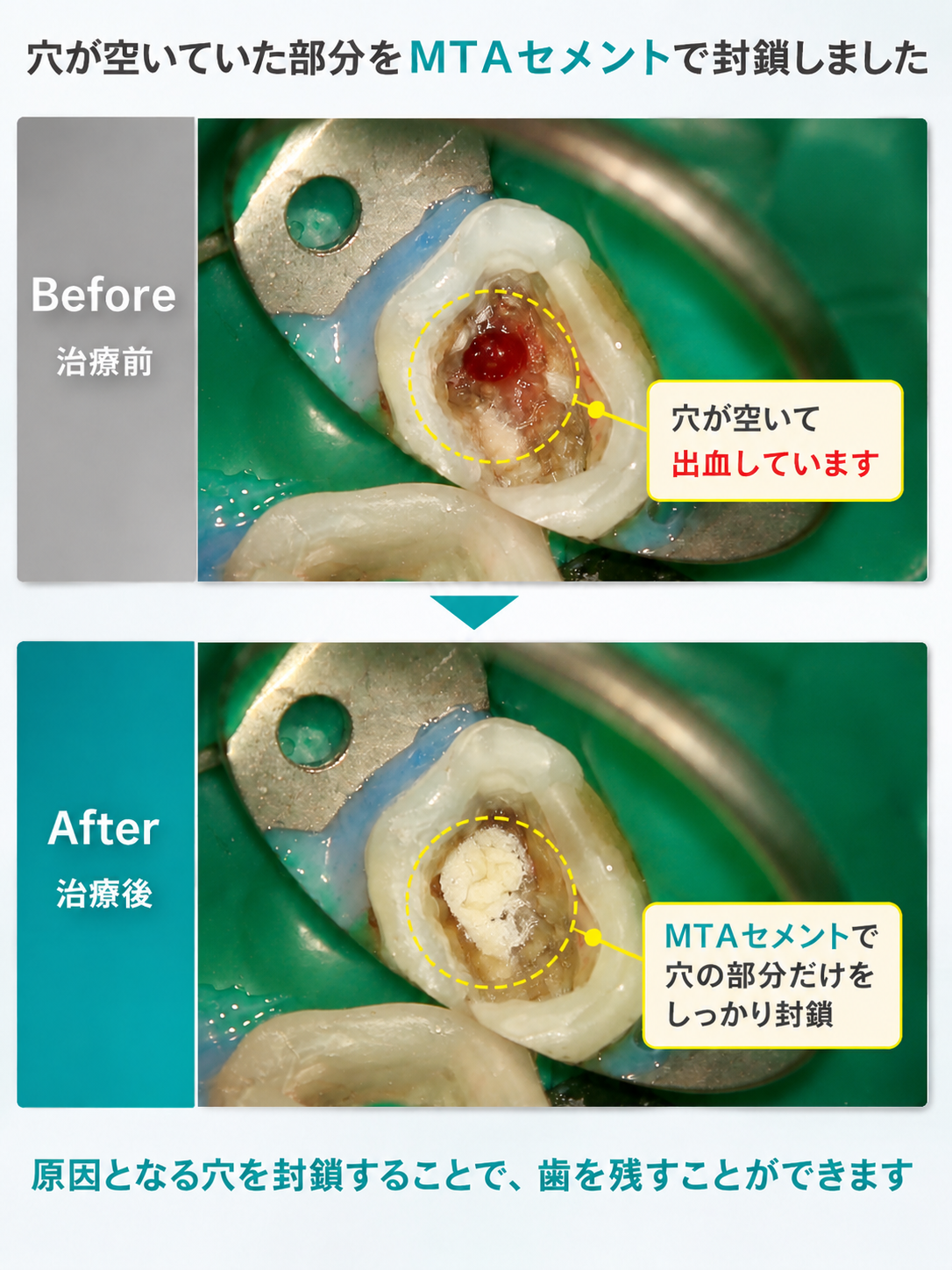 根管治療ってどんな治療？痛くないの？｜綱島の歯医者・高田歯科クリニック