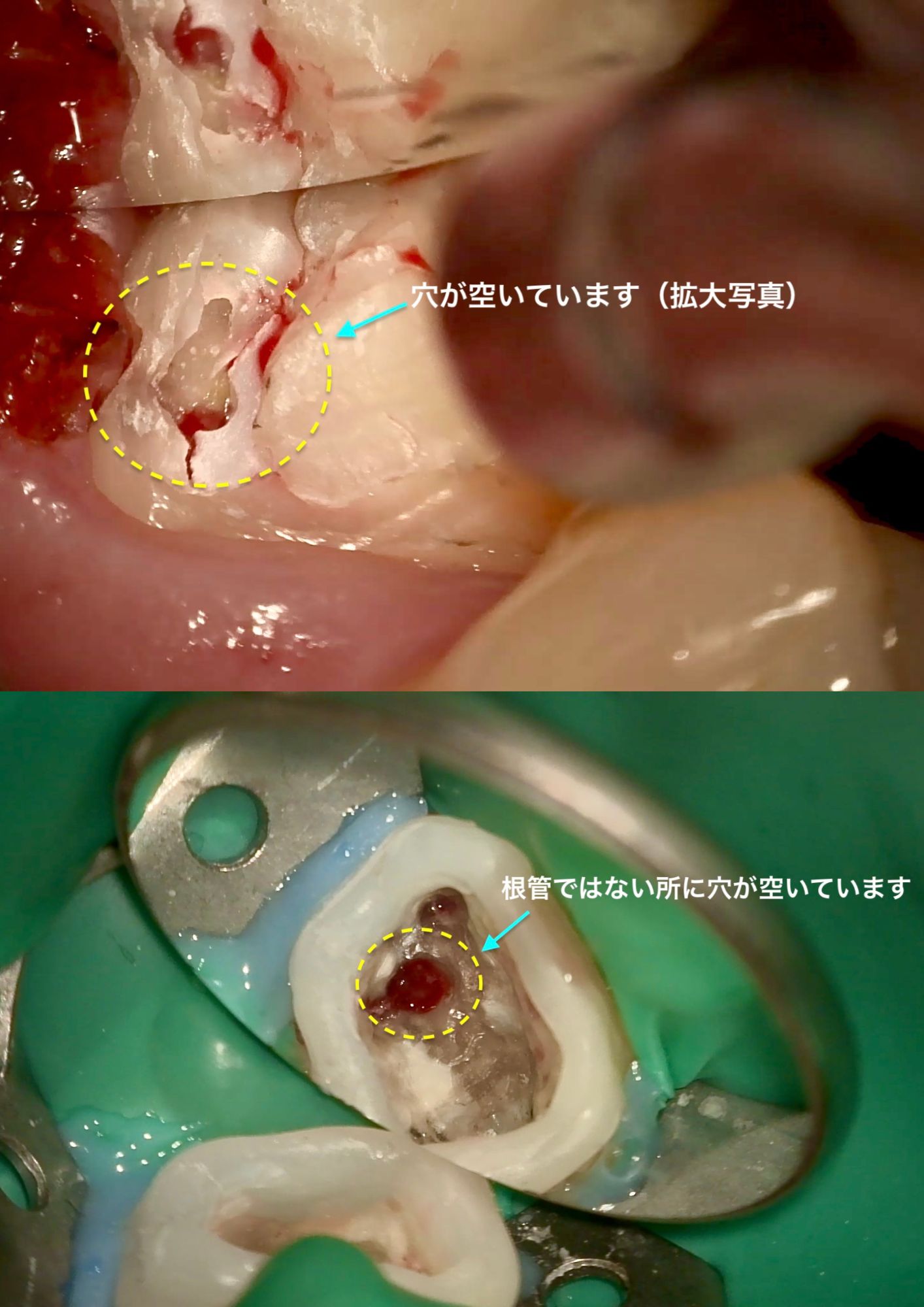 根管治療ってどんな治療？痛くないの？｜綱島の歯医者・高田歯科クリニック