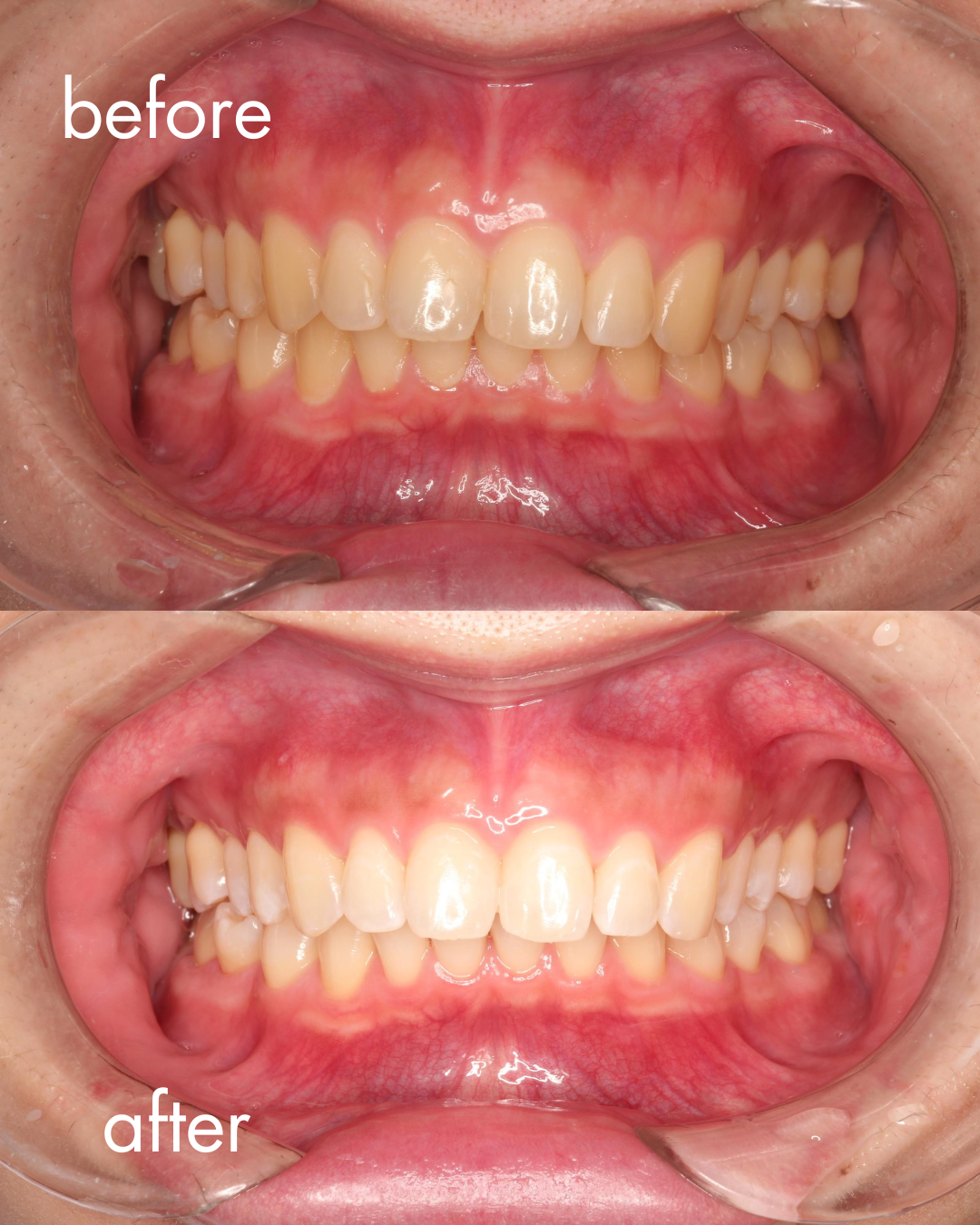 夏前に始めたい！綱島のホワイトニングなら高田歯科クリニック｜種類・料金・効果を解説