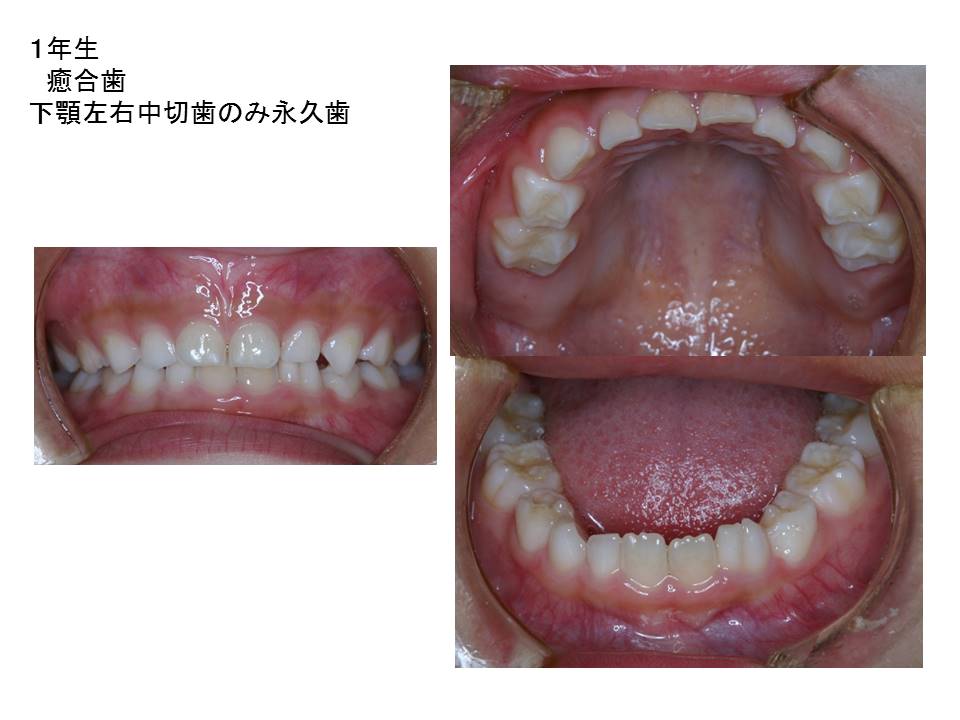 子供の歯の生え変わりガイド